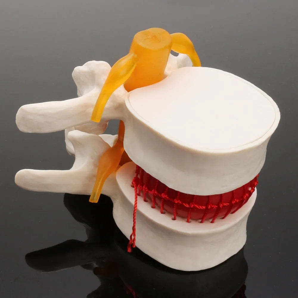 White PVC lumbar disc herniation demonstration model for medical education