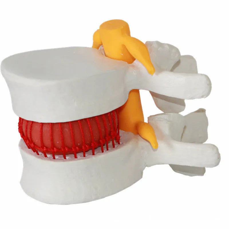 White PVC lumbar disc herniation demonstration model for medical education