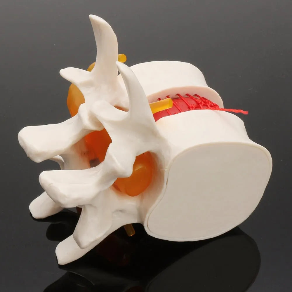 White PVC lumbar disc herniation demonstration model for medical education