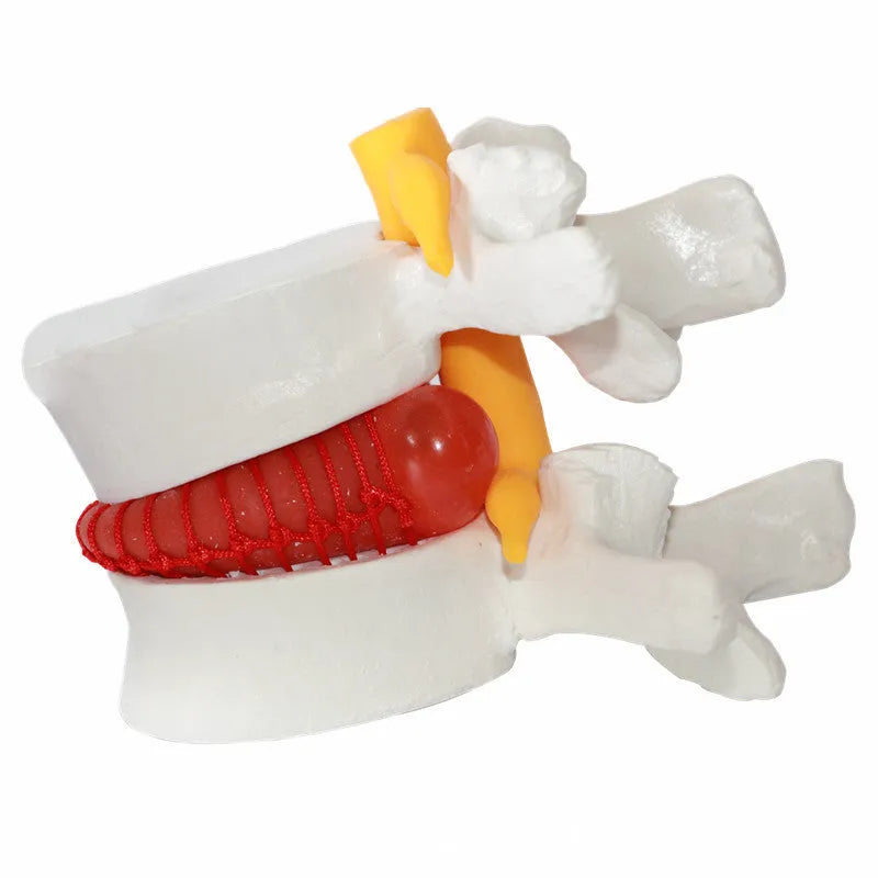 White PVC lumbar disc herniation demonstration model for medical education
