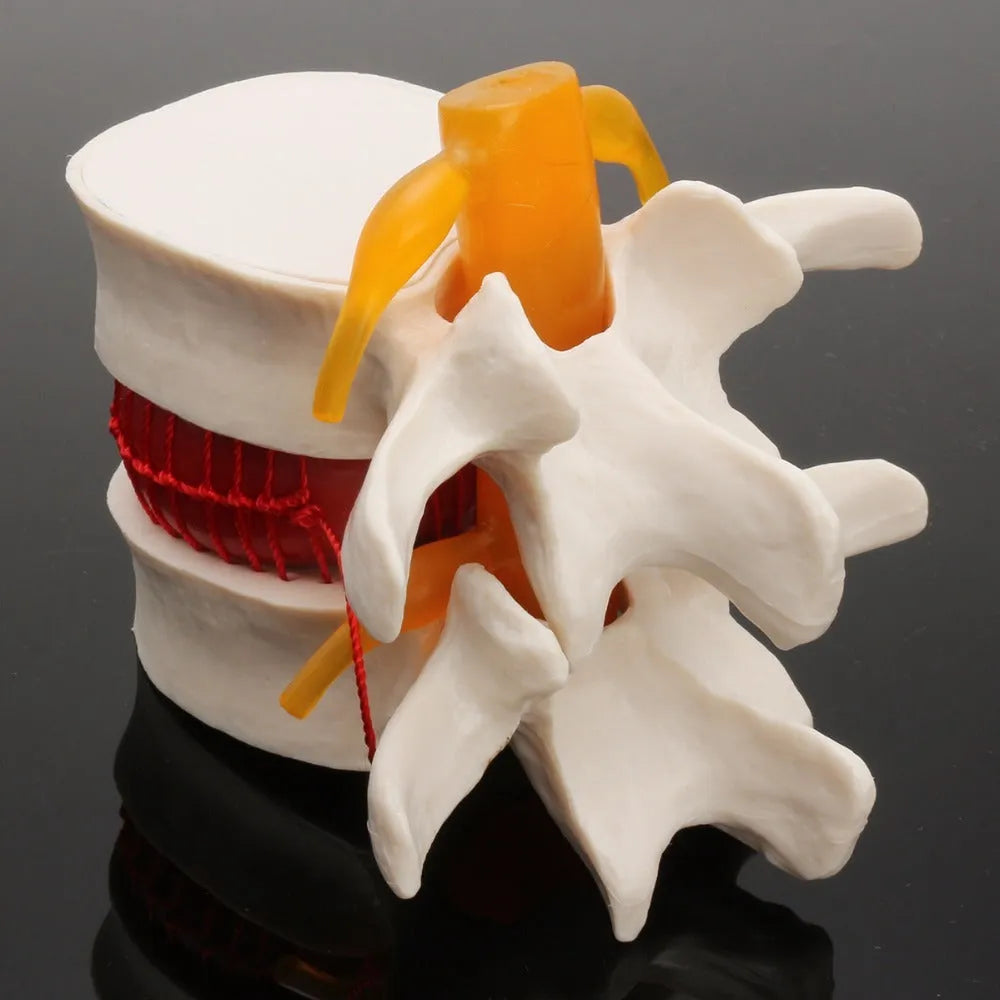 White PVC lumbar disc herniation demonstration model for medical education