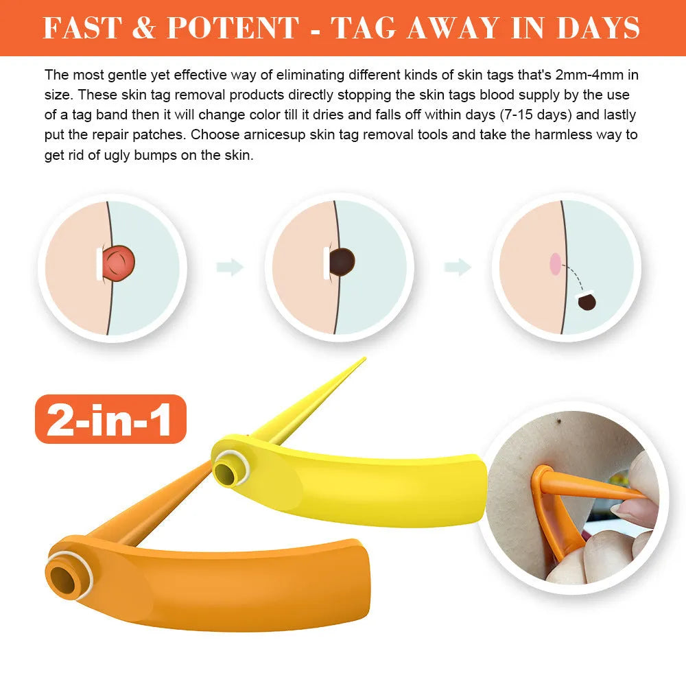 Orange yellow wart removal device kit with rubber rings, cones, alcohol swabs, and repair sticker.
