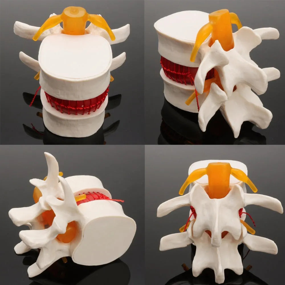 White PVC lumbar disc herniation demonstration model for medical education