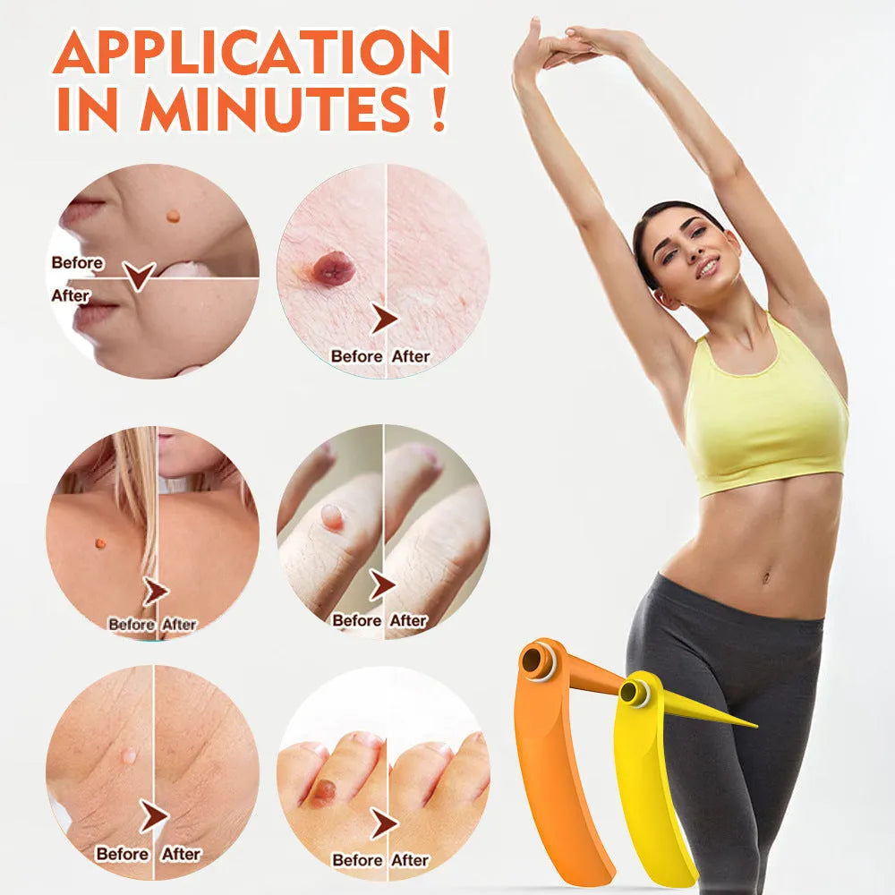 Orange yellow wart removal device kit with rubber rings, cones, alcohol swabs, and repair sticker.