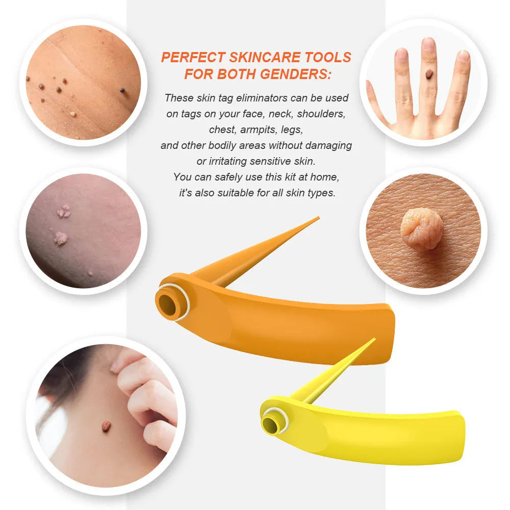Orange yellow wart removal device kit with rubber rings, cones, alcohol swabs, and repair sticker.